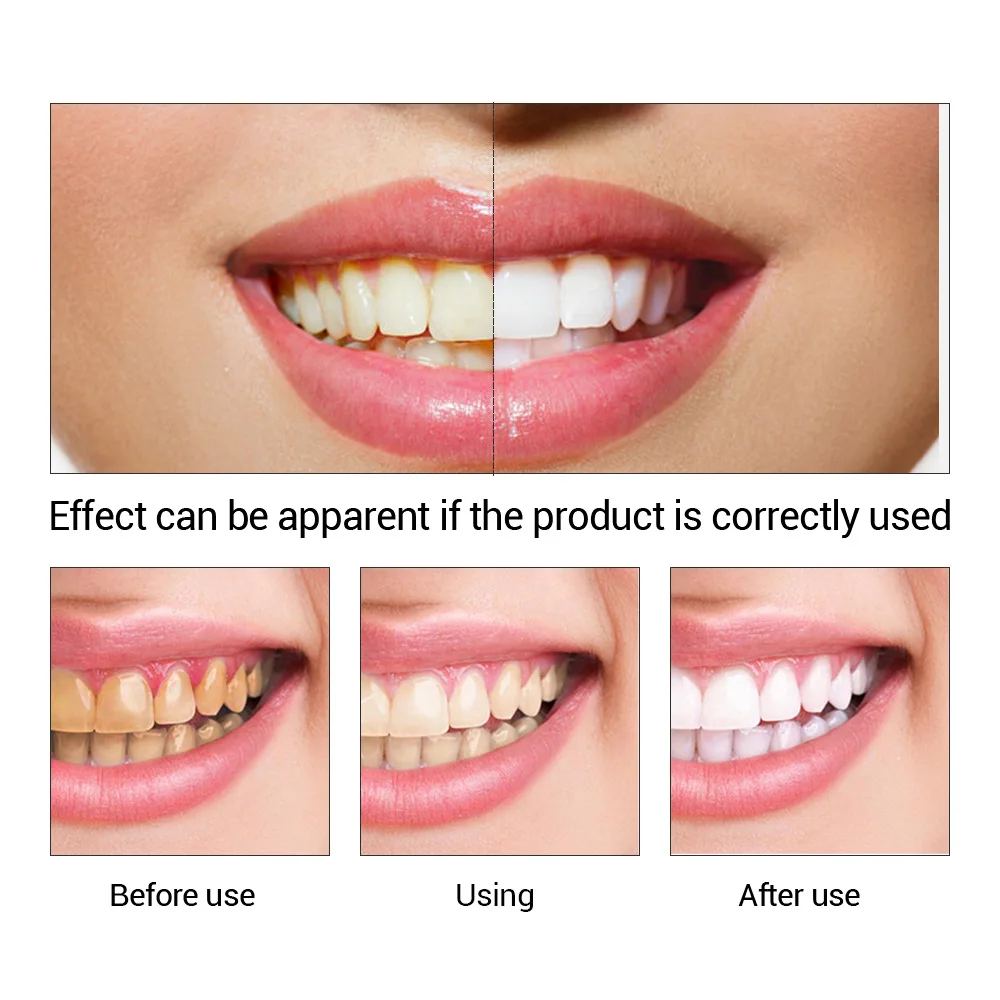 FTEENPLY Teeth Whitening Essen - Teeth Whitening Procedure recension och pris
